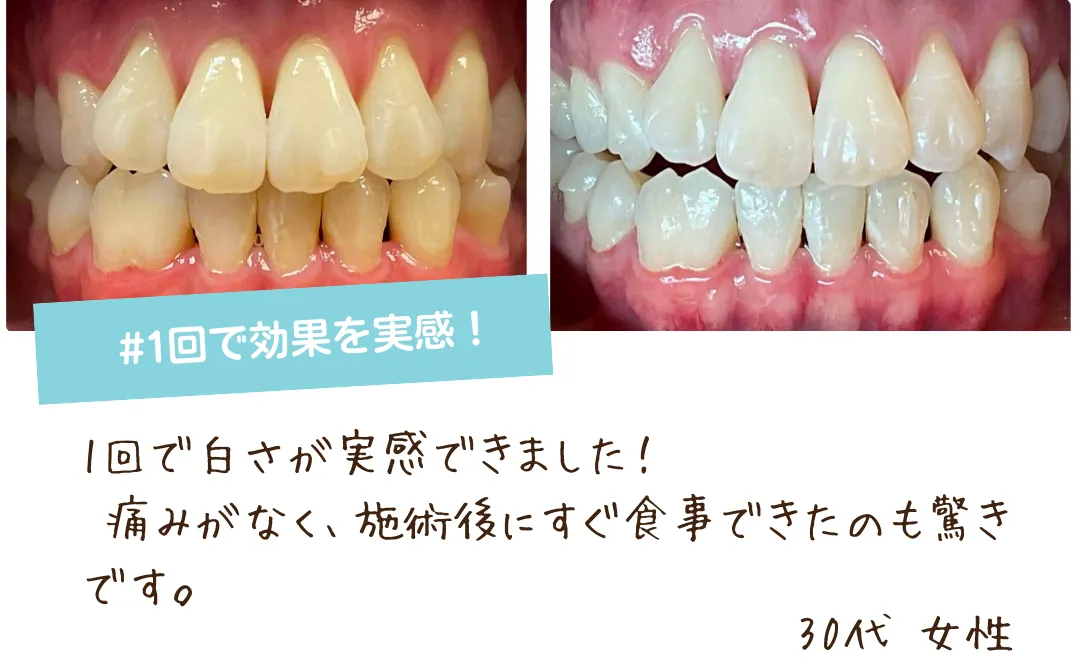 １回で効果実感のセルフホワイトニング