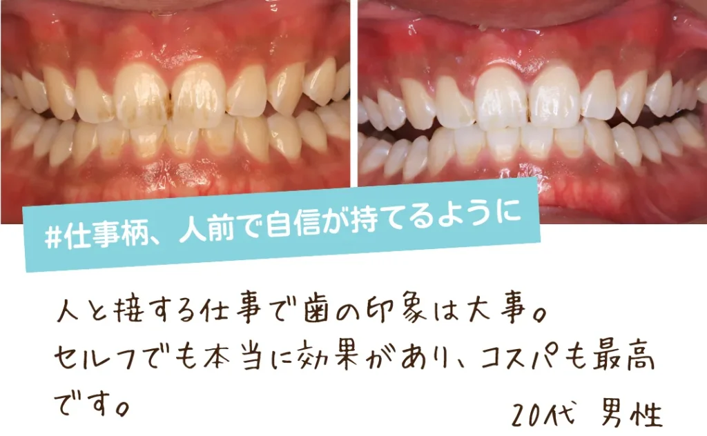 京橋で安いセルフホワイトニングの口コミ