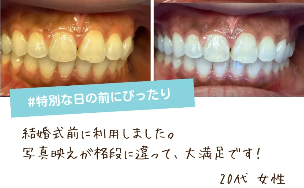 結婚式前のセルフホワイトニングの口コミ