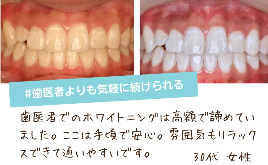 大阪で安いセルフホワイトニングの口コミ